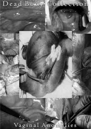 Dead Body Collection - Vaginal Anomalies