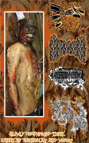 SxIxCxUxPxRxSxCxOxAxBxAxIxWx / Pulmonary Embolism / Vasoepididymostomy / Mx ...