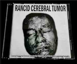 Rancid Cerebral Tumor - Cerebral Autosomal Dominant Arteriophaty With Subcortical Infarcts And Leukoencephalopathy