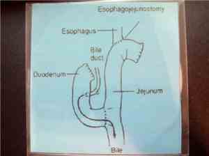Esophagojejunostomy - Demo #1
