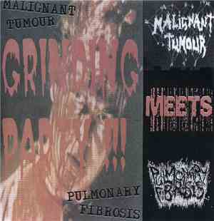 Malignant Tumour / Pulmonary Fibrosis - Grinding Party !!!